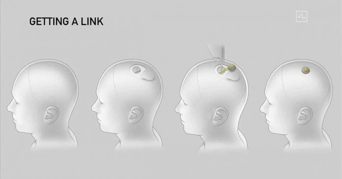 prototype of Neuralink brain implant